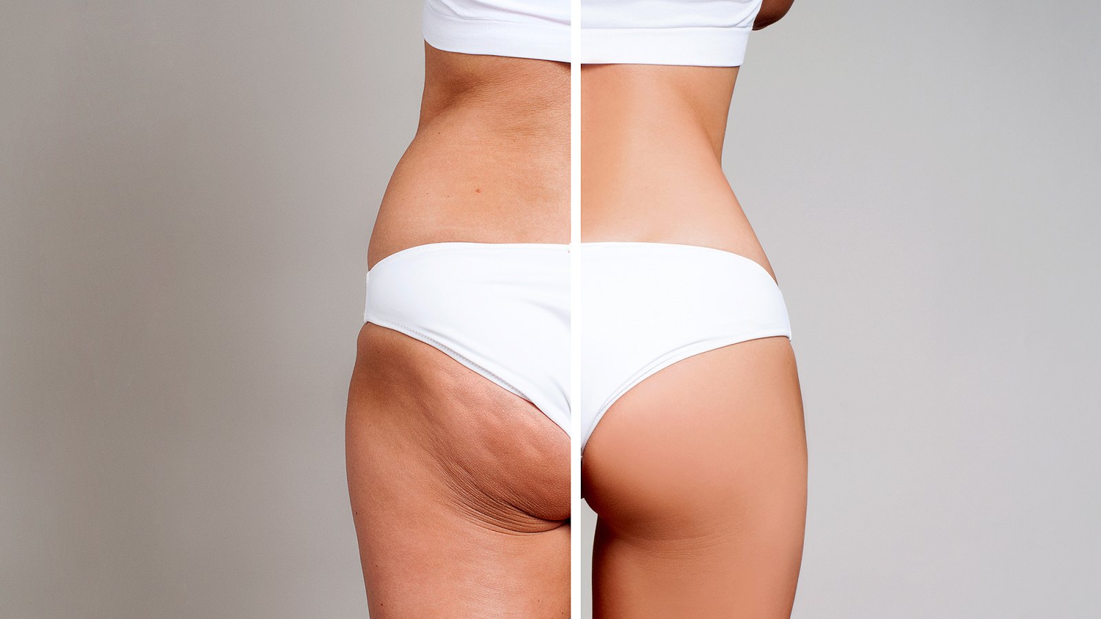 cellulite-treatments-for-women