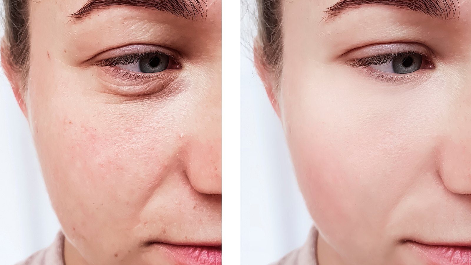 hyaluronic-acid-before-after