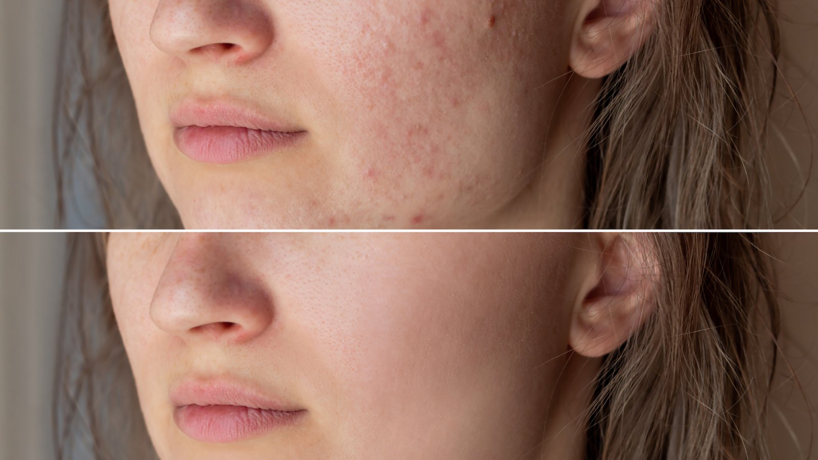 Before-After-Acne-Skin-Stock-Photo