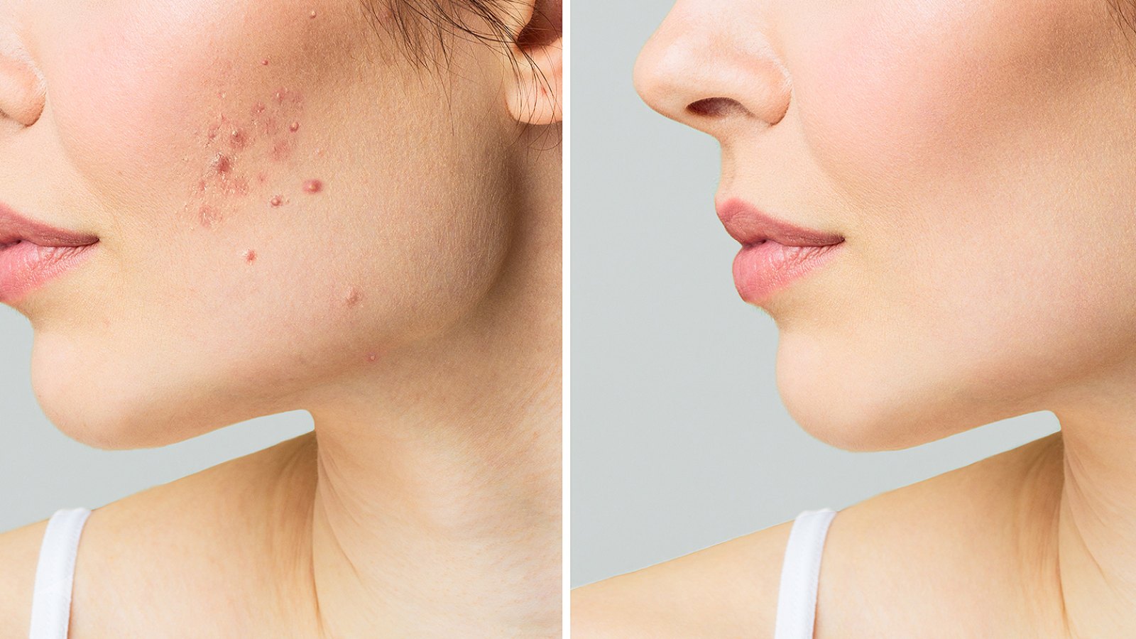 malin-and-goetz-acne-treatment-overnight