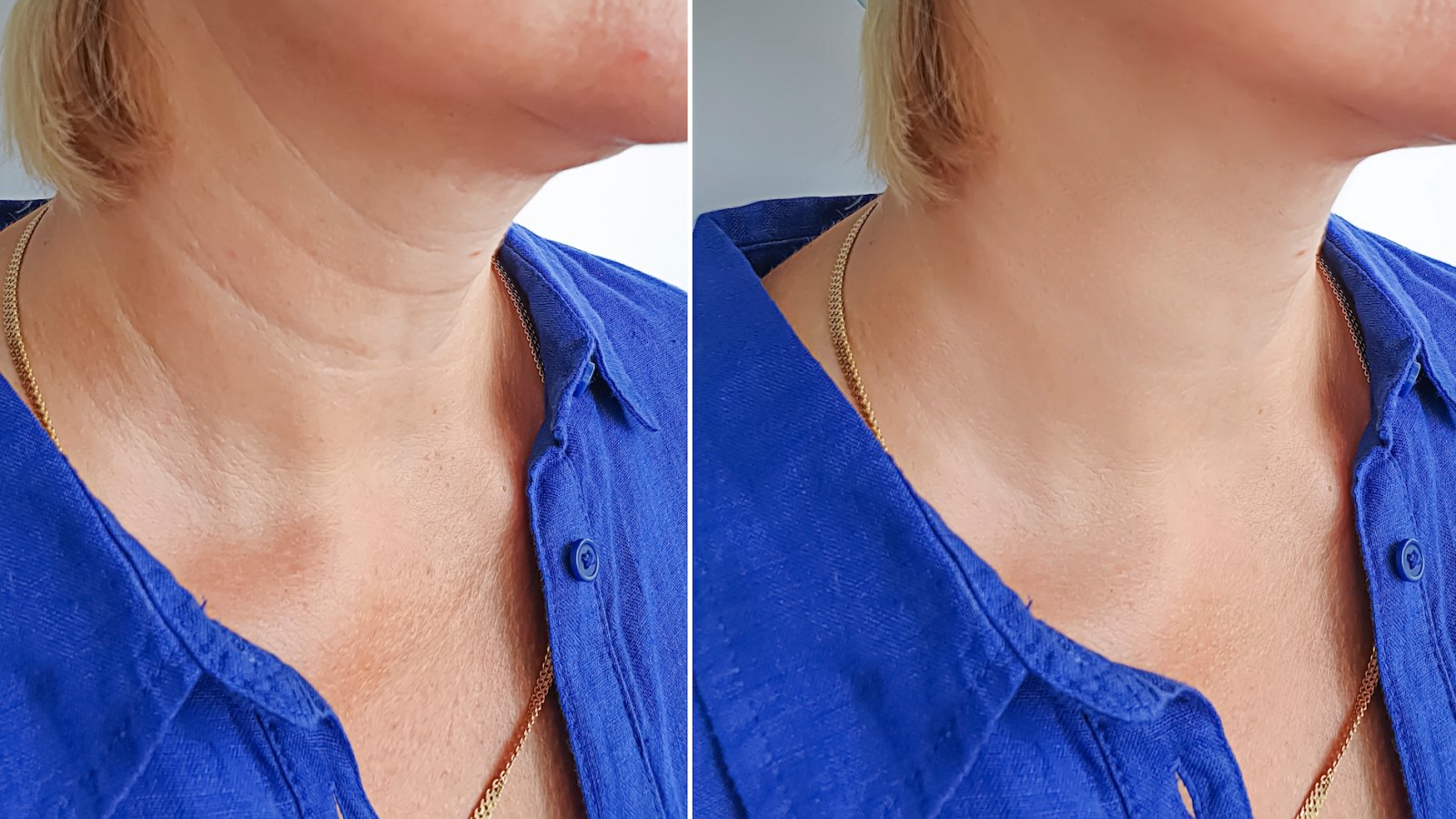 Neck-Tightening-Before-After-Stock-Photo