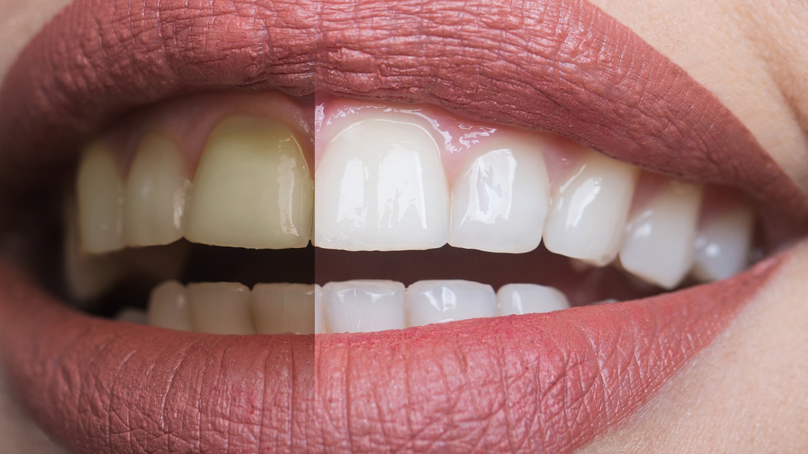 amazon-teeth-whitening-foam