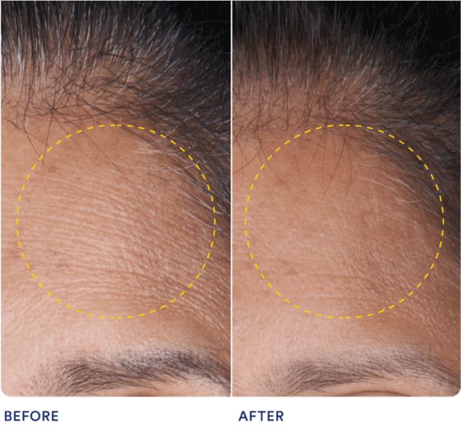 Ritual HyaCera Before and After
