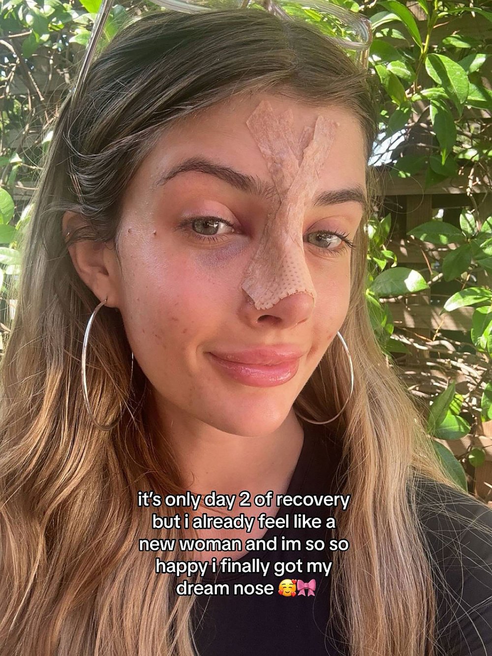 Sami Sheen Gets a Nose Job 9 Months After Breast Implants TikTok 7