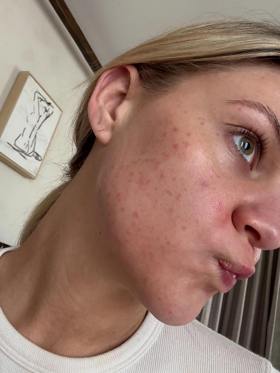 Kelsea Ballerini They Get Stress Rashes Just Like Us