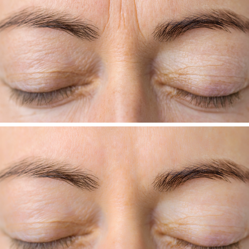 Woman's face skin before and after aesthetic beauty cosmetic procedures with removed skin wrinkles